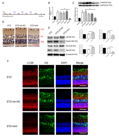 TXNIP regulates autophagy and apoptosis in diabetic patients