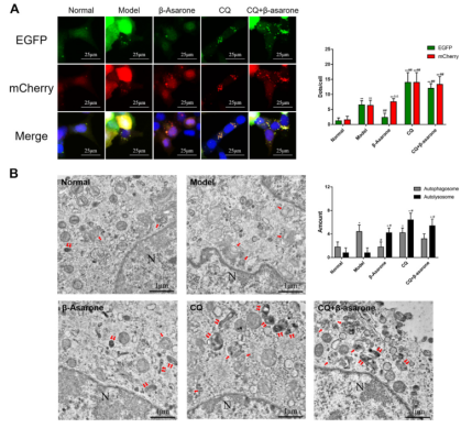 TXNIP regulates autophagy and apoptosis in diabetic patients